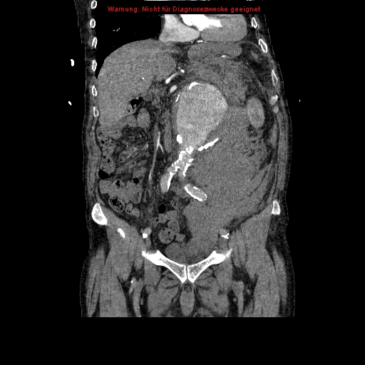 Abdominal aortic aneurysm- extremely large, ruptured (Radiopaedia 19882-19921 Coronal C+ arterial phase 46).jpg