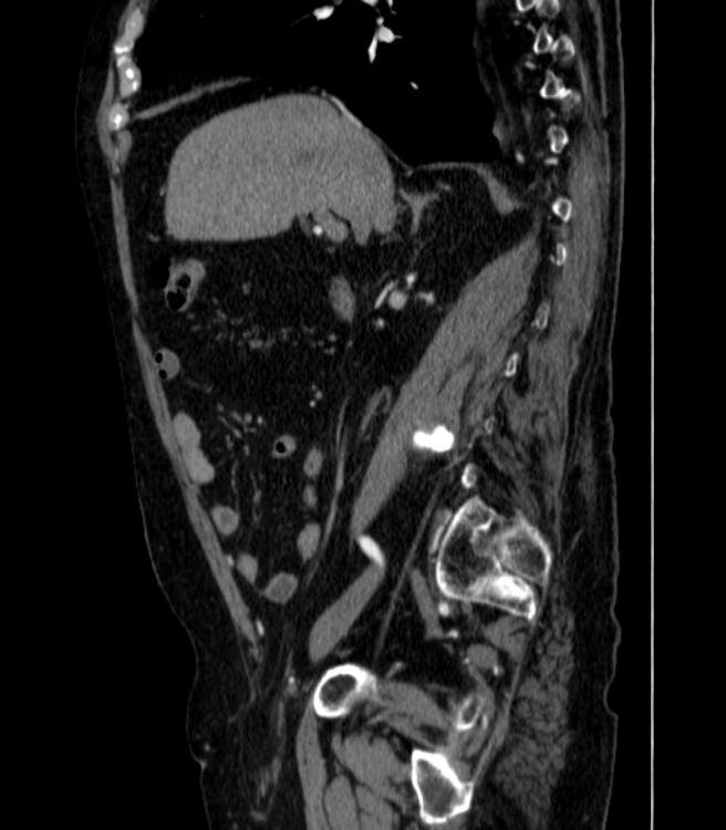 Abdominal aortic aneurysm (Radiopaedia 25855-26001 Sagittal C+ arterial phase 8).jpg
