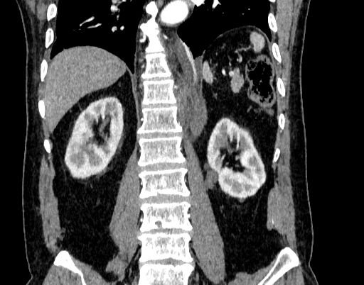 Abdominal aortic aneurysm (Radiopaedia 67117-76452 Coronal C+ arterial phase 73).jpg