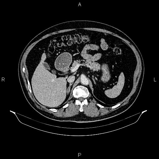 Abdominal aortic aneurysm (Radiopaedia 83094-97462 Axial renal cortical phase 82).jpg