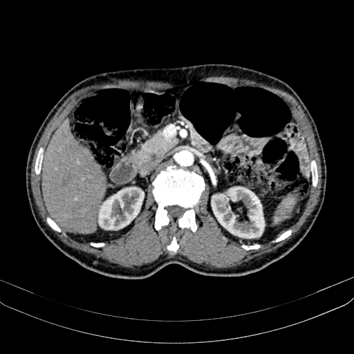 File:Abdominal aortic aneurysm (Radiopaedia 83581-98689 Axial C+ arterial phase 46).jpg