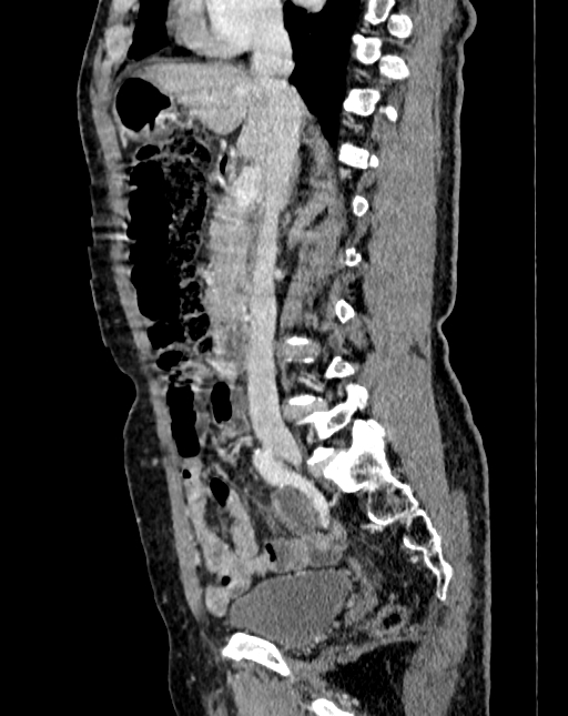 Abdominal aortic aneurysm (Radiopaedia 83581-98689 Sagittal C+ portal venous phase 30).jpg