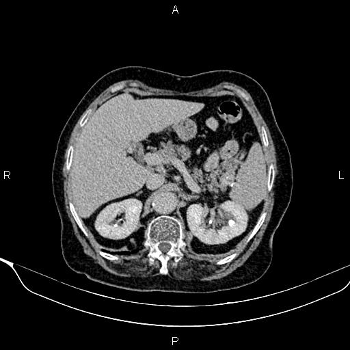Abdominal aortic aneurysm (Radiopaedia 85063-100606 Axial C+ delayed 21).jpg