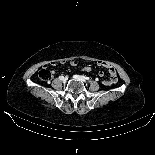 File:Abdominal aortic aneurysm (Radiopaedia 85063-100606 Axial C+ portal venous phase 51).jpg