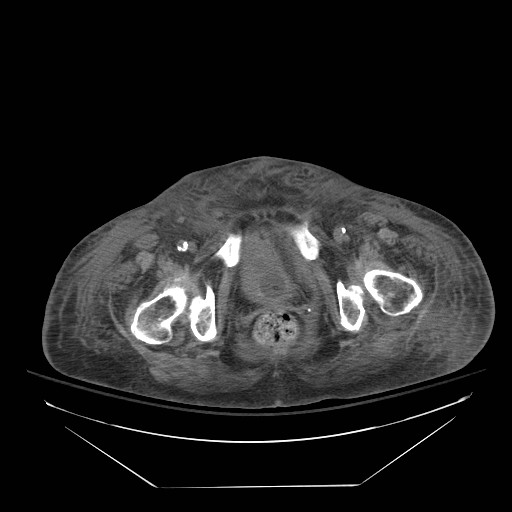 Abdominal aortic aneurysm - impending rupture (Radiopaedia 19233-19247 Axial non-contrast 163).jpg