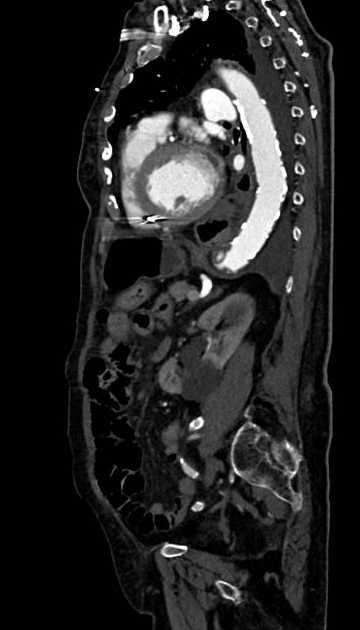 Abdominal aortic aneurysm with thrombus fissuration (Radiopaedia 73192-83919 Sagittal C+ arterial phase 46).jpg