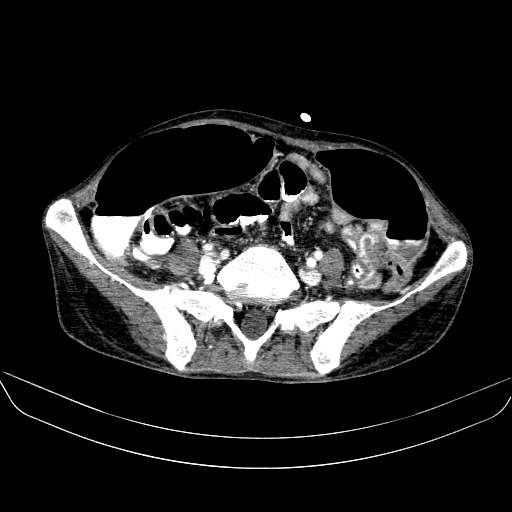 File:Abdominal collection due to previous cecal perforation (Radiopaedia 80831-94320 Axial C+ portal venous phase 143).jpg
