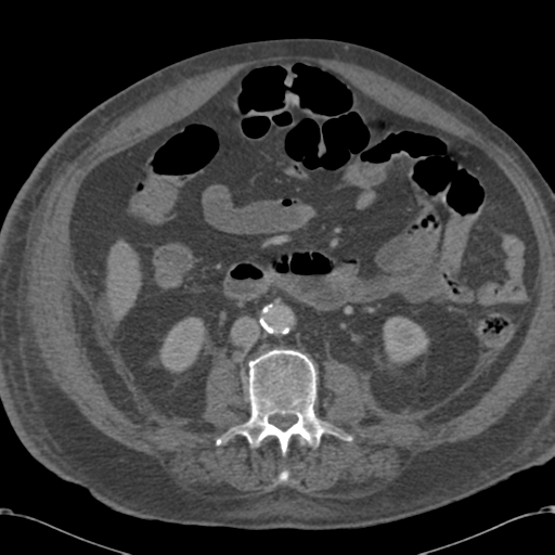 Abdominal hematoma (Radiopaedia 33614-34715 Axial C+ portal venous phase 64).png