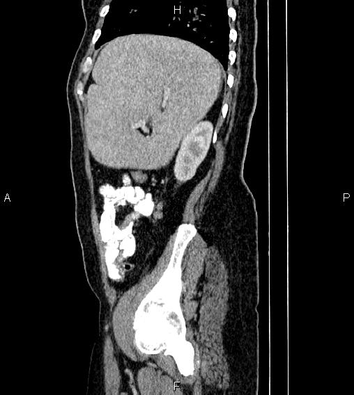 Abdominal lymphoma with sandwich sign (Radiopaedia 84378-99704 Sagittal C+ portal venous phase 74).jpg
