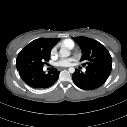 Abdominal multi-trauma - devascularised kidney and liver, spleen and pancreatic lacerations (Radiopaedia 34984-36486 Axial C+ arterial phase 44).png