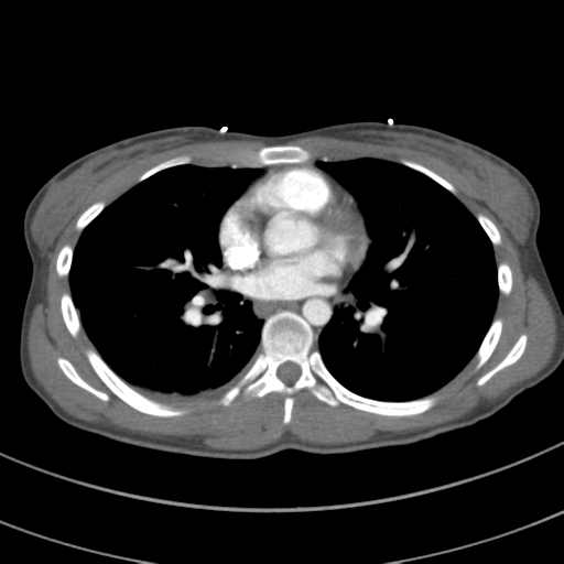 Abdominal multi-trauma - devascularised kidney and liver, spleen and pancreatic lacerations (Radiopaedia 34984-36486 Axial C+ arterial phase 46).png