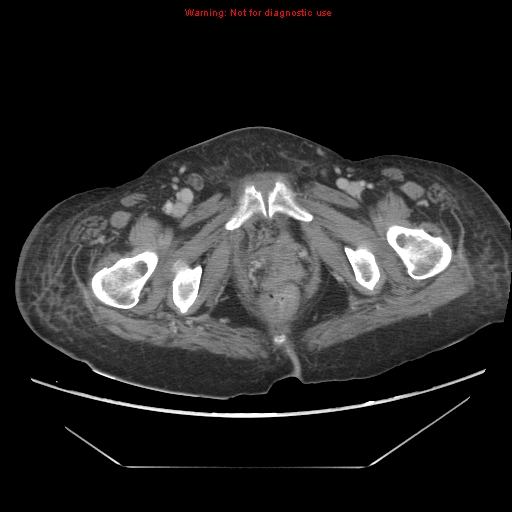 File:Abdominal wall hematoma (Radiopaedia 9427-10112 Axial C+ portal venous phase 108).jpg