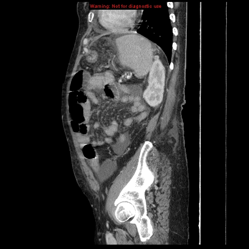 Abdominal wall hematoma (Radiopaedia 9427-10112 Sagittal C+ portal venous phase 28).jpg