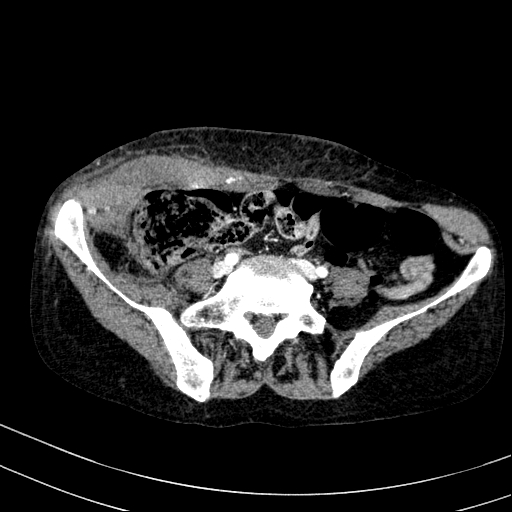 Abdominal wall hematoma with active bleeding (Radiopaedia 83915-99117 Axial renal cortical phase 87).jpg