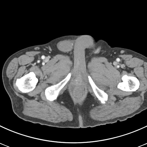 Abdominal wall metastasis from colorectal carcinoma (Radiopaedia 31016-31717 Axial C+ portal venous phase 83).jpg