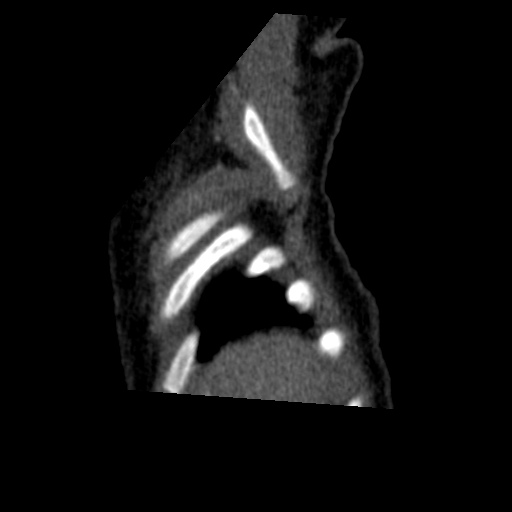 Aberrant left pulmonary artery (pulmonary sling) (Radiopaedia 42323-45435 Sagittal C+ arterial phase 2).jpg