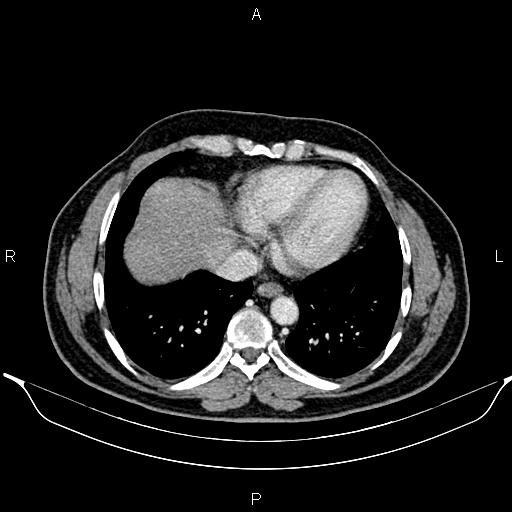 Aberrant right subclavian artery (Radiopaedia 87093-103354 Axial With contrast 82).jpg