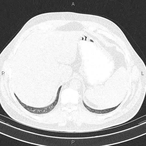 Aberrant right subclavian artery (Radiopaedia 87093-103354 Axial lung window 101).jpg