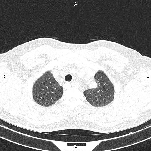 Aberrant right subclavian artery (Radiopaedia 87093-103354 Axial lung window 20).jpg