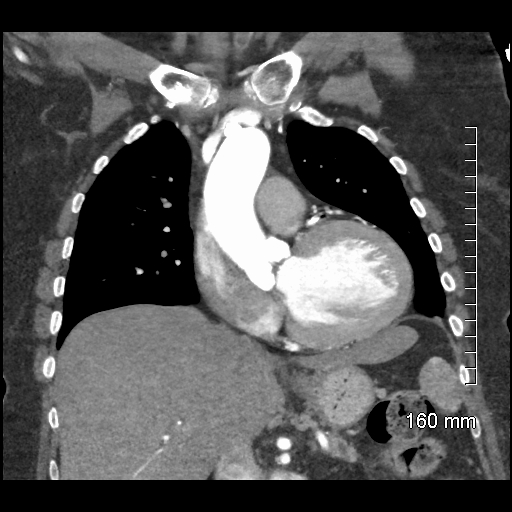 Aberrant right subclavian artery stenosis (Radiopaedia 52656-58670 B 38).jpg