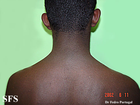 File:Acanthosis Nigricans-Benign (Dermatology Atlas 6).jpg