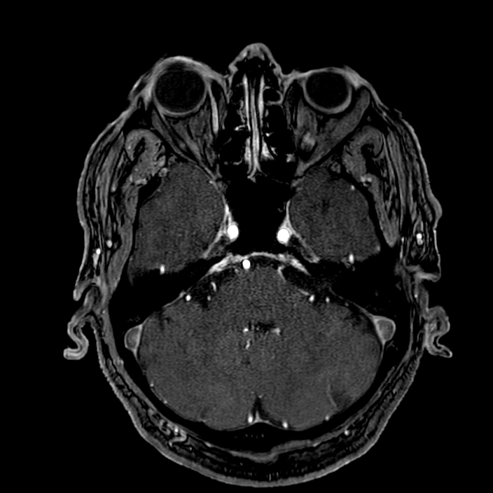 Accessory middle cerebral artery (Radiopaedia 73114-83828 Axial MRA 40).jpg