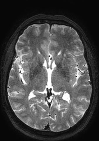 Accessory middle cerebral artery (Radiopaedia 73114-83828 Axial T2 70).jpg