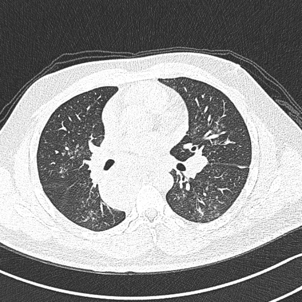 Achalasia with aspiration (Radiopaedia 55413-61845 Axial lung window 35).jpg