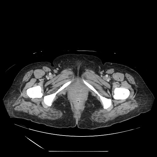 Acinar cell carcinoma of the pancreas (Radiopaedia 75442-86669 Axial C+ portal venous phase 155).jpg