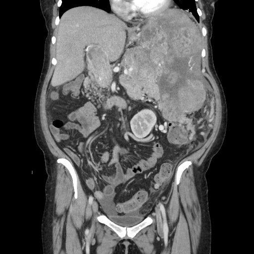 Acinar cell carcinoma of the pancreas (Radiopaedia 75442-86669 Coronal C+ portal venous phase 54).jpg