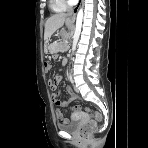 Acinar cell carcinoma of the pancreas (Radiopaedia 75442-86669 Sagittal C+ portal venous phase 100).jpg