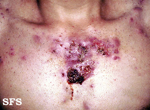 File:Acne Fulminans (Dermatology Atlas 1).jpg