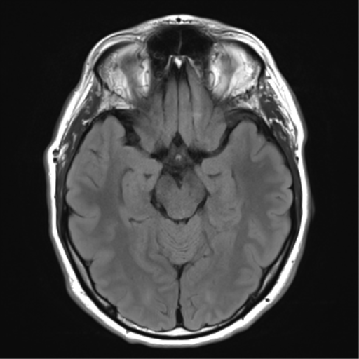 File:Acoustic schwannoma (Radiopaedia 50846-56358 Axial FLAIR 13).png