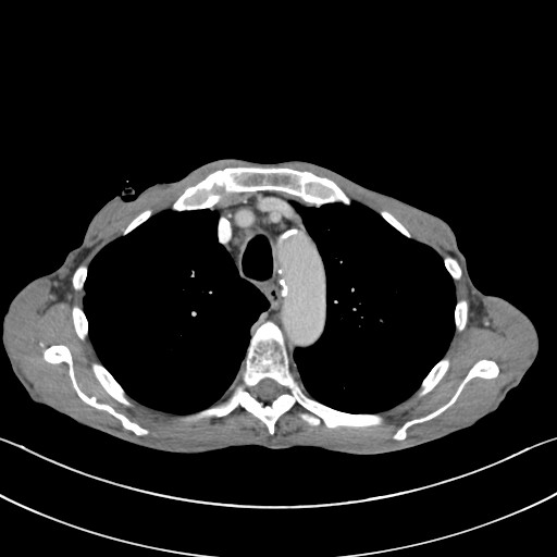 File:Acquired tracheoesophageal fistula (Radiopaedia 57747-65042 Axial C+ portal venous phase 25).jpg