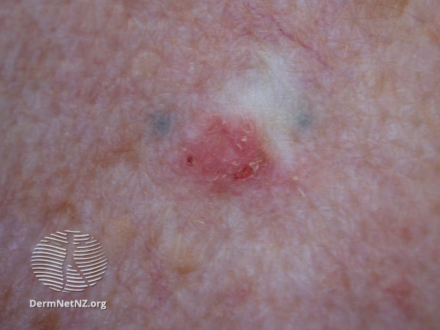 Actinic Keratoses affecting the face (DermNet NZ lesions-ak-face-399).jpg