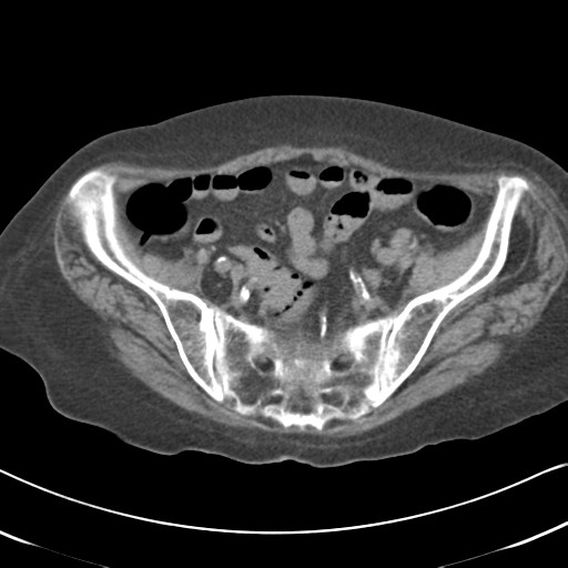 Active bleeding from duodenal ulcer with embolization (Radiopaedia 34216-35481 Axial non-contrast 50).png
