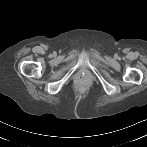 File:Active bleeding from duodenal ulcer with embolization (Radiopaedia 34216-35481 Axial non-contrast 74).png