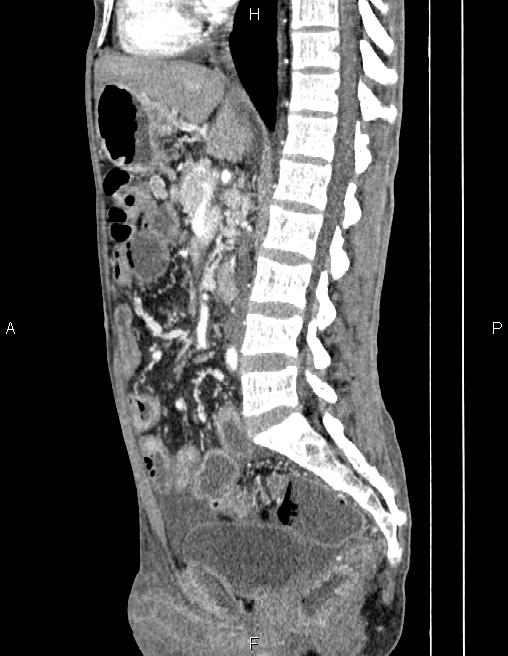 Active crohn disease (Radiopaedia 87133-103397 Sagittal C+ arterial phase 44).jpg