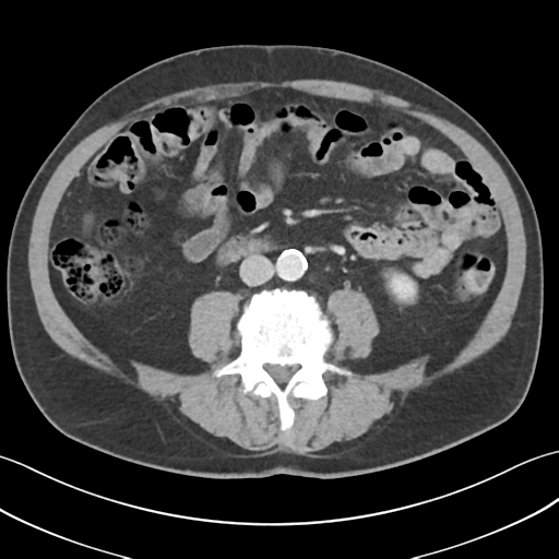 File:Active diverticular hemorrhage (Radiopaedia 39415-41725 Axial C+ portal venous phase 36).png