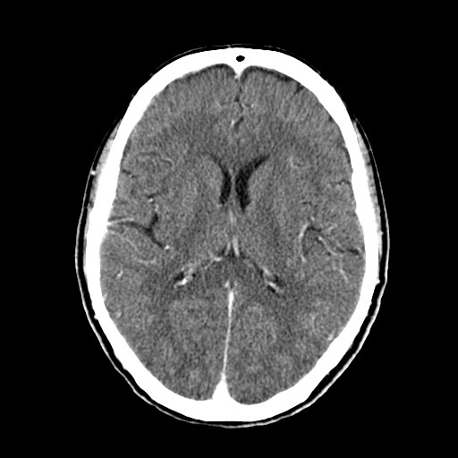 File:Active neurocysticercosis before and after therapy (Radiopaedia 71710-82100 Axial C+ delayed 51).jpg