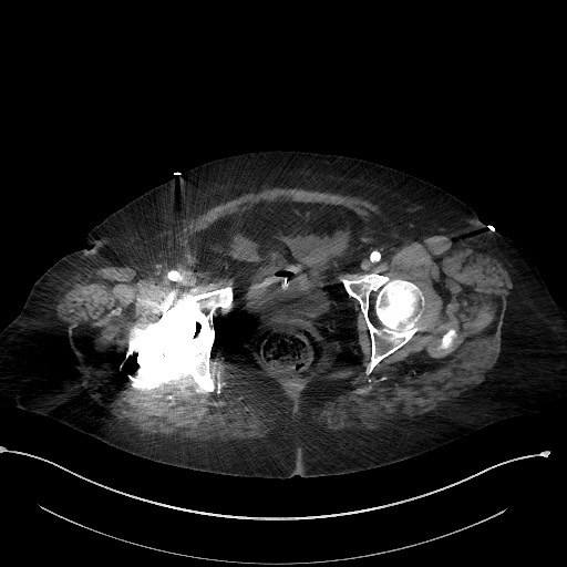 Active renal extravasation with large subcapsular and retroperitoneal hemorrhage (Radiopaedia 60975-68796 Axial C+ arterial phase 187).jpg