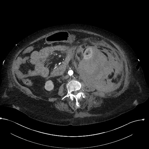 Active renal extravasation with large subcapsular and retroperitoneal hemorrhage (Radiopaedia 60975-68796 Axial C+ arterial phase 98).jpg