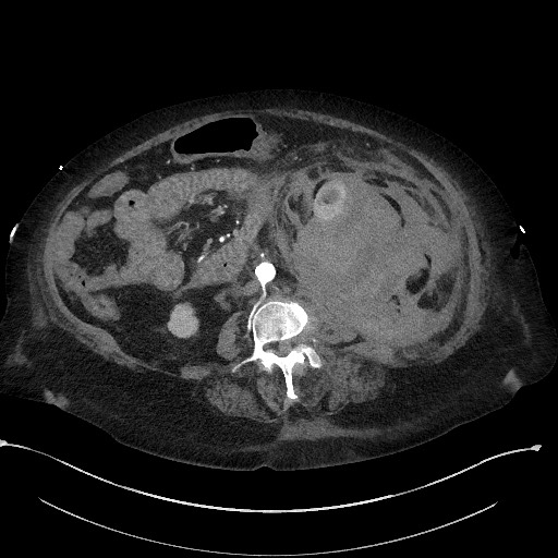 Active renal extravasation with large subcapsular and retroperitoneal hemorrhage (Radiopaedia 60975-68796 Axial C+ arterial phase 99).jpg