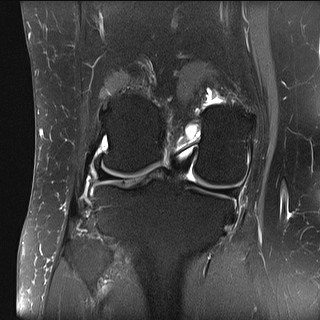 File:Acute-on-chronic transient lateral patellar dislocation with trochlear dysplasia (Radiopaedia 84099-99349 Coronal PD fat sat 16).jpg