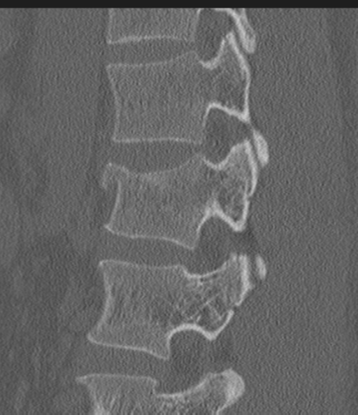 Acute L1 burst compression fracture (Radiopaedia 34430-35755 Sagittal bone window 24).png