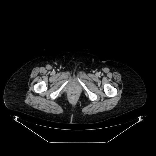 Acute appendicitis, heterotaxy syndrome (Radiopaedia 66884-76202 Axial C+ portal venous phase 137).jpg