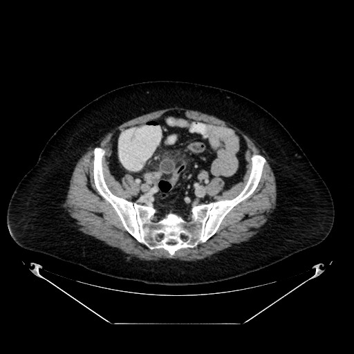 File:Acute appendicitis, heterotaxy syndrome (Radiopaedia 66884-76202 Axial C+ portal venous phase 99).jpg