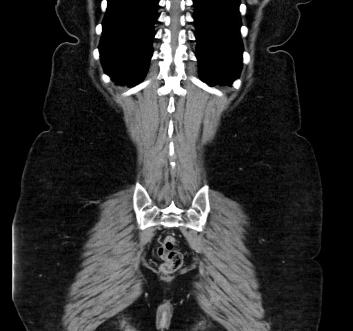Acute appendicitis, heterotaxy syndrome (Radiopaedia 66884-76202 Coronal C+ portal venous phase 106).jpg