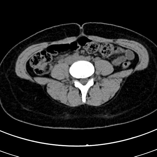 Acute appendicitis (Radiopaedia 30261-30888 Axial non-contrast 53).jpg