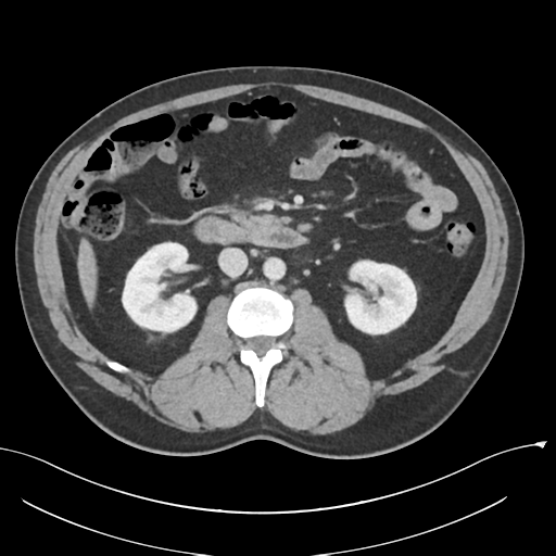 Acute appendicitis (Radiopaedia 36611-38177 Axial C+ portal venous phase 43).png
